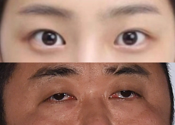 对比：理想眼睑（上）与睡眼眼睑（下）