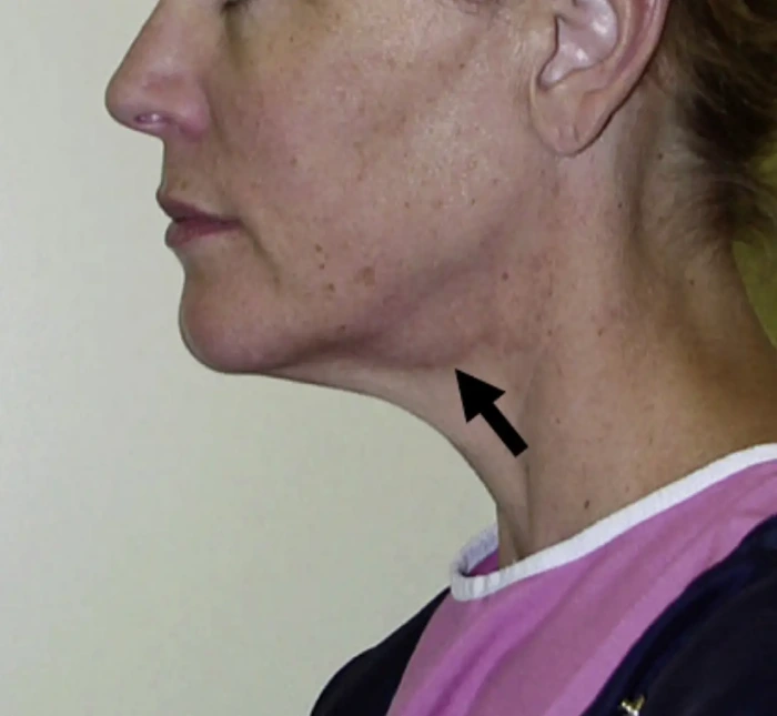 visible submandibular glands causing fullness