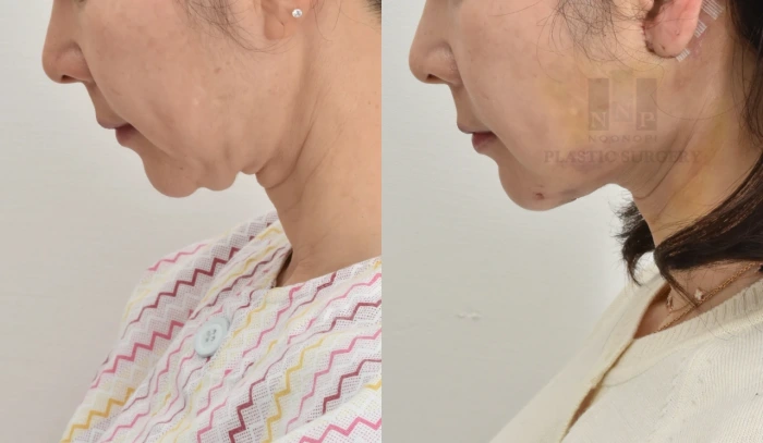 2 weeks after neck lift with additional skin tightening