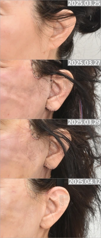 Facelift incision scar timeline
