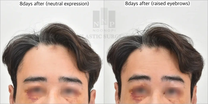 Preserved brow movement after safe surgery