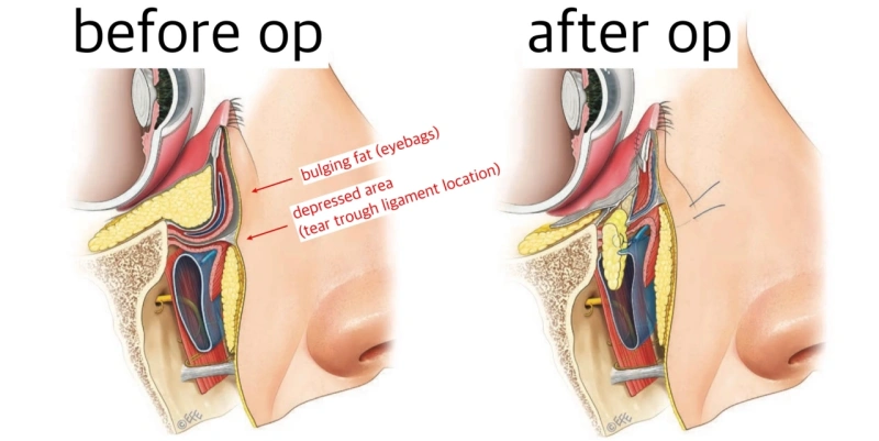 كيف تعمل إعادة وضع الدهون عبر الملتحمة