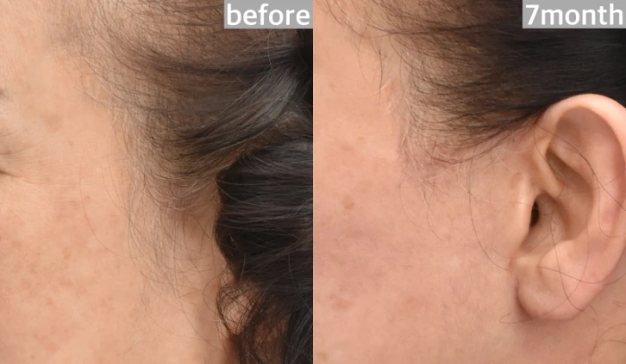 حالة شق على طول خط الشعر، تكبير