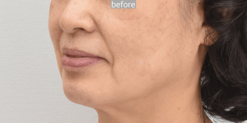 Before and seven month after Face and neck lift together