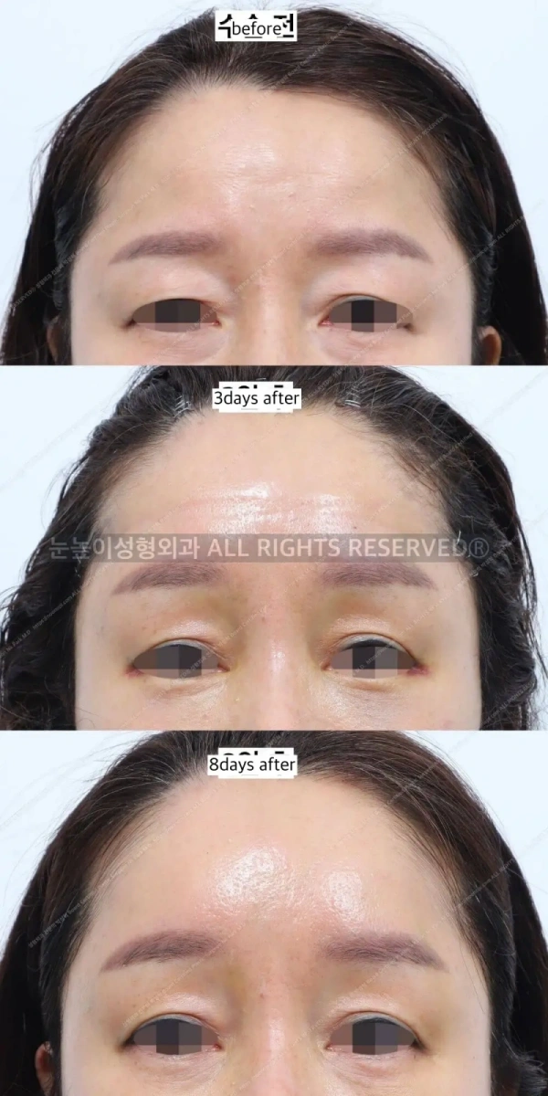 Early postoperative swelling after endoscopic brow lift