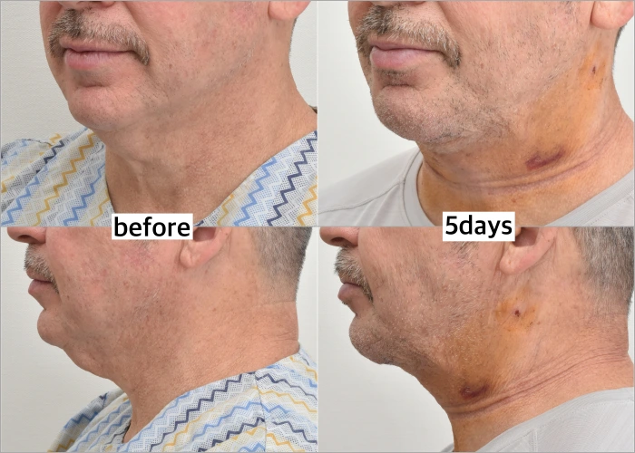 Neck Lift Before and After Photo of Patient in His 50s from a Different Angle