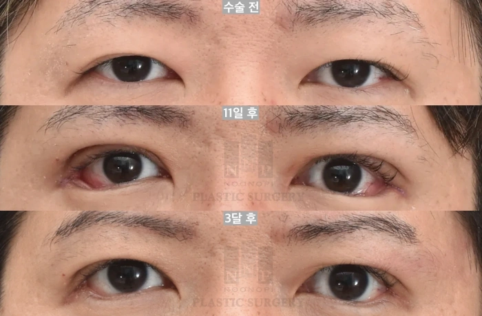 术后11天与3个月对比图