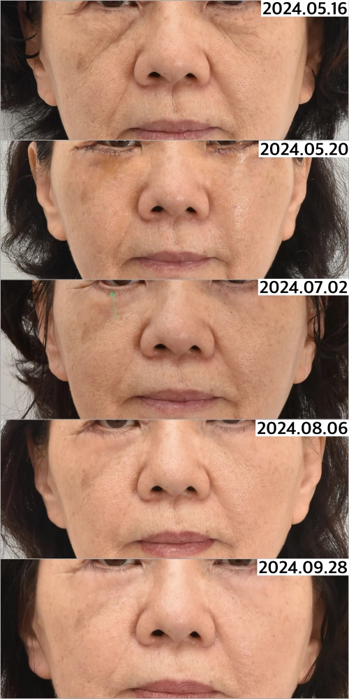 canthoplasty