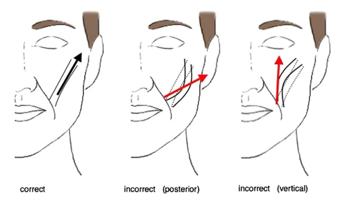 Correct SMAS elevation direction vs. incorrect direction during deep plane facelift