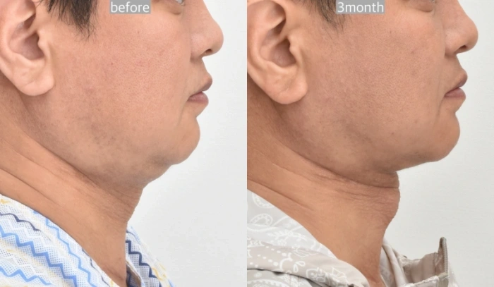 جراحة الرقبة المزدوجة في كوريا