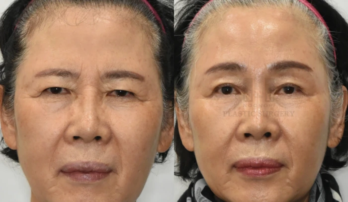 眼部手术以减轻强烈的印象