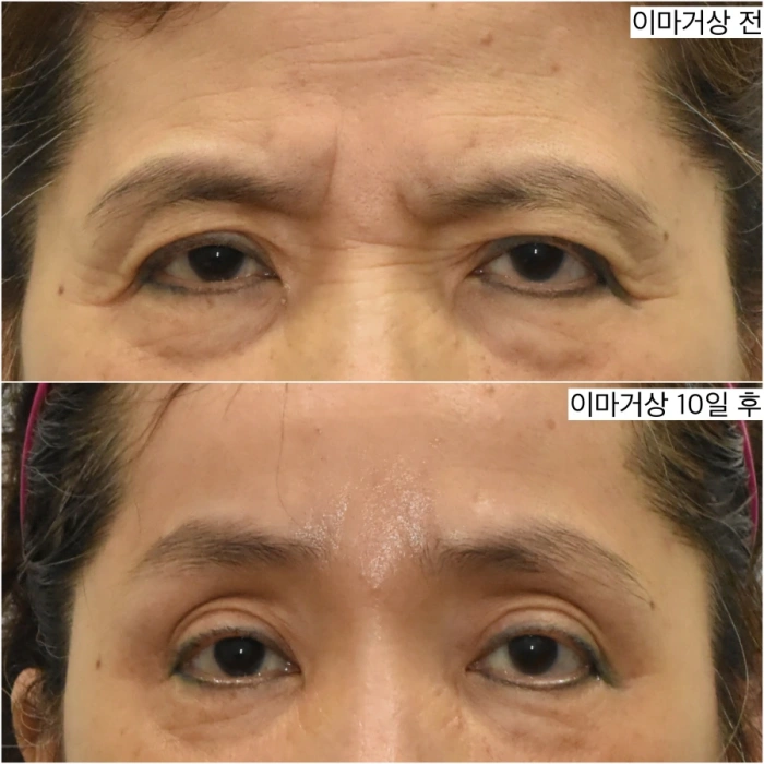 10days after forehead lift