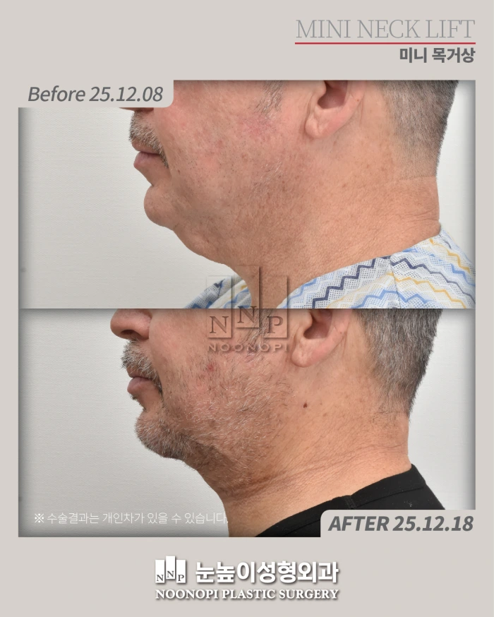 10days post results of Mini neck lift
