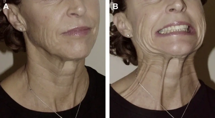 颈阔肌:静态与动态状态