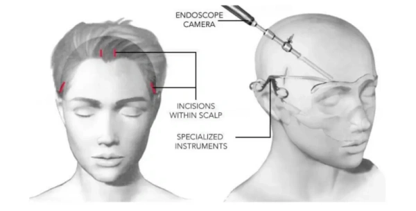 额部提升术切口位置