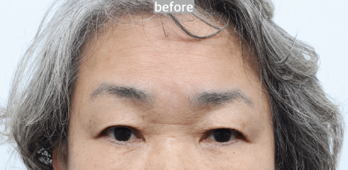 术前术后对比图显示眉高变化极小