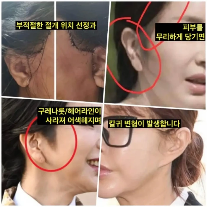 김건희 안면거상 후 구레나룻 사라진 사례