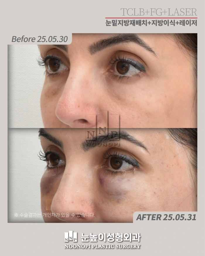 مريضة ترغب في ملء التجويف في الجفن السفلي بزراعة الدهون.