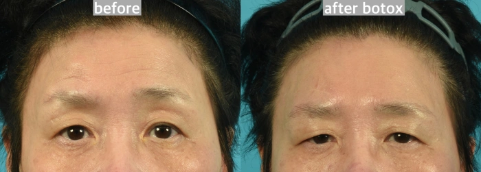 이마보톡스를 맞고 눈 주위 인상이 바뀐 사례