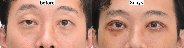 unilateral ptosis surgery korea