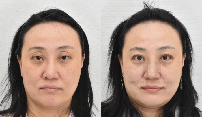 겹쌍꺼풀과 졸린눈을 안검하수 실비로 진행한 사례