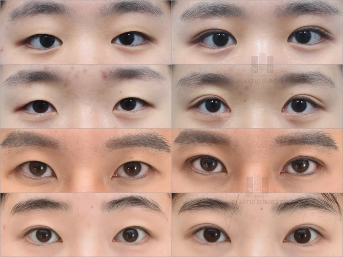 non incisional blepharoplasty before after
