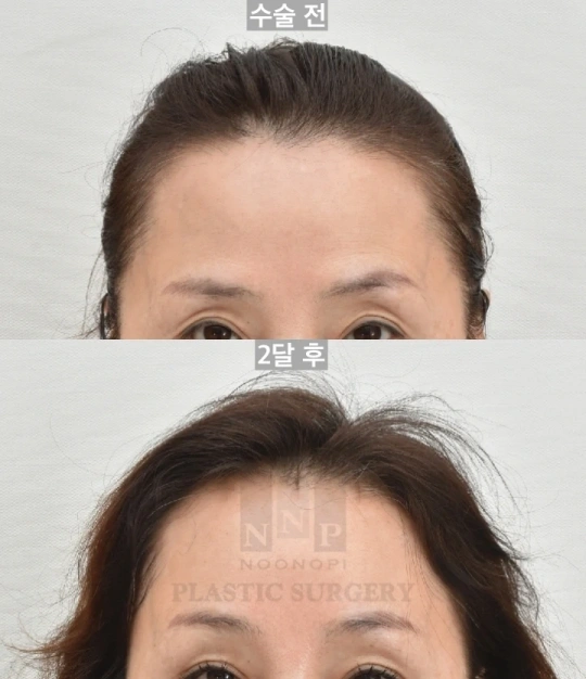 이마거상 후 부기 내시경이마거상 후 부기 경과