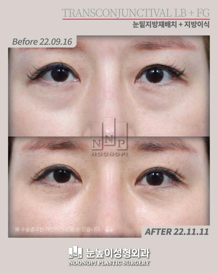 lower lid fat graft