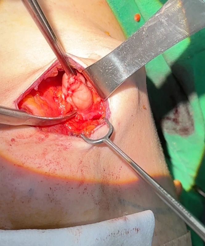 مشهد لتقليل الغدة تحت الفك السفلي في عيادة نونوبي