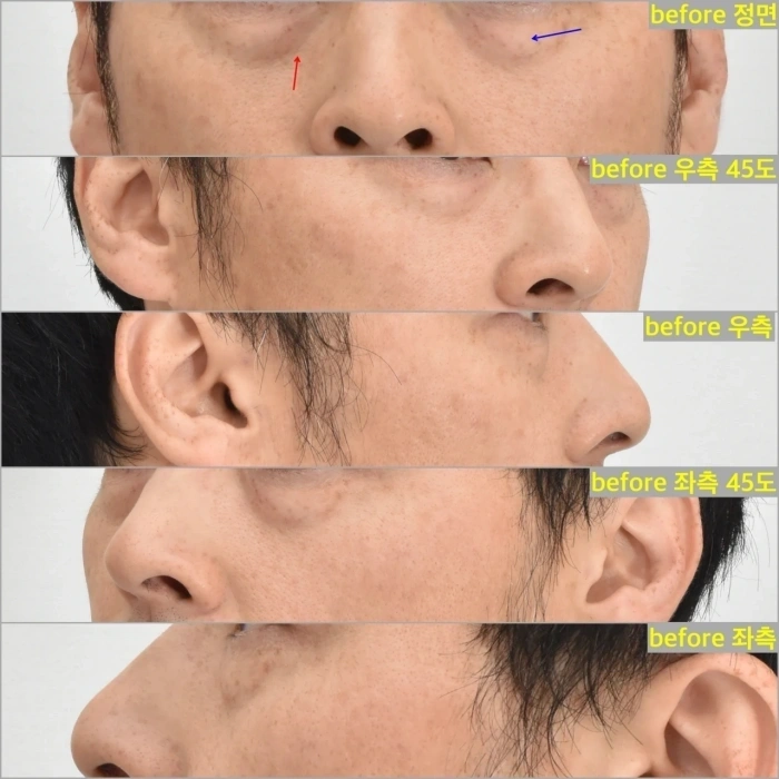 الجفون السفلية النموذجية المتقدمة في السن