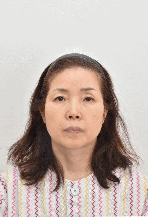 眉下提升术、下睑成形术及上睑脂肪填充术（术后2个月）