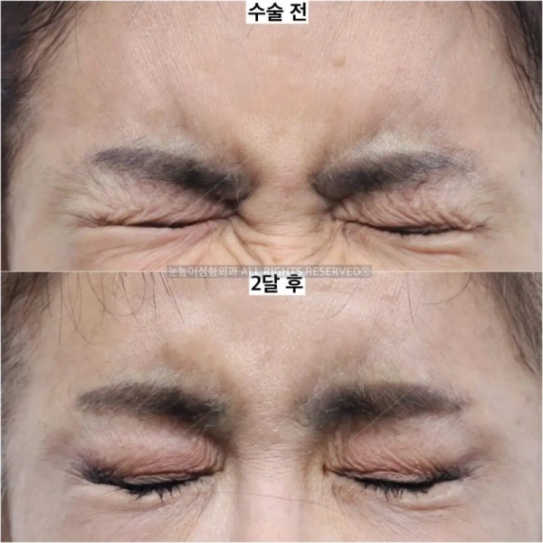 미간근육이 충분히 절제된 이마거상 사례
