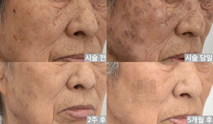 강한 IPL 치료시 물집이 생길 수 있다