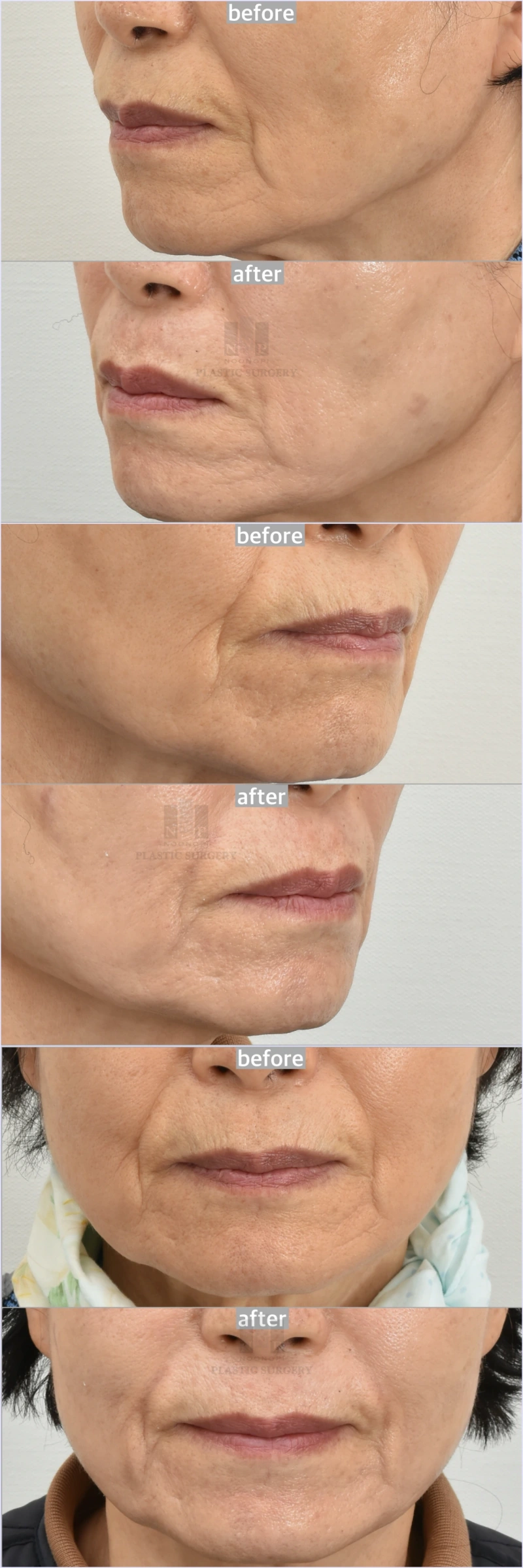 Perioral fine wrinkle improvement after 3 sessions