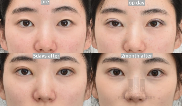 non incisional double eyelid before after