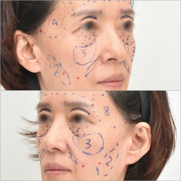 精准规划脂肪量、移植区及穿刺点