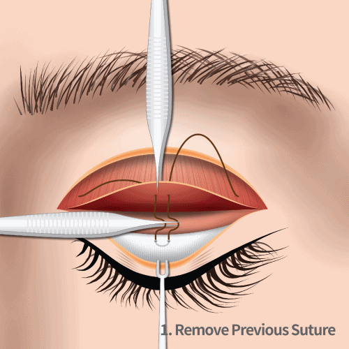 Fine-tuning levator advancement process for elderly ptosis correction