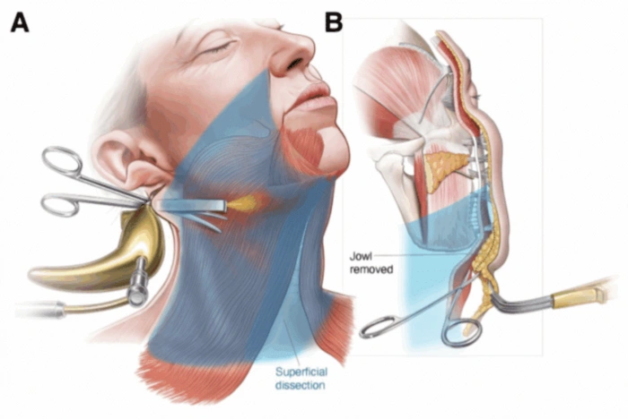 仅在耳后留微小切口的内窥镜面部提升术