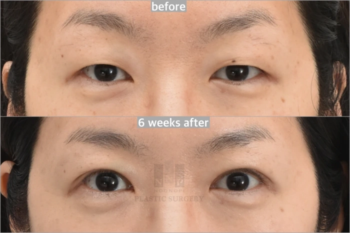 upper blepharoplasty with ptosis correction 6weeks after