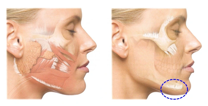 mandibular retaining ligament