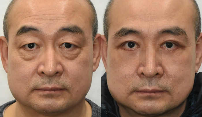 上眼睑提升术联合下眼睑整形