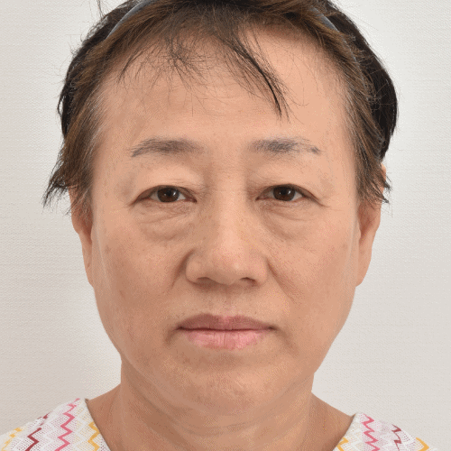 lower blepharoplasty korea before after