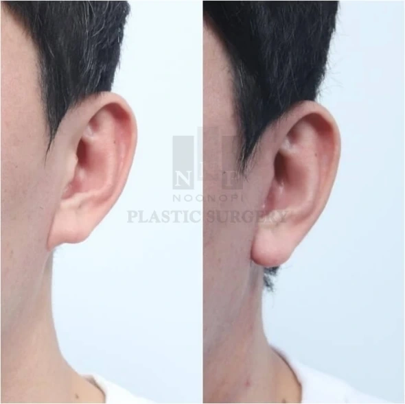 Noonopi耳垂重塑术(先天性粘连耳垂)