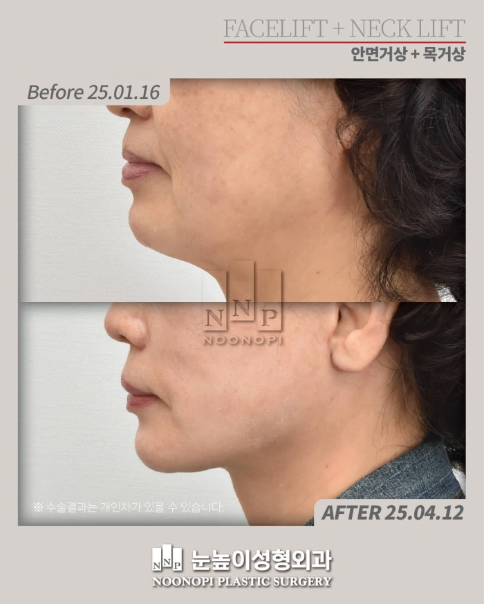 before after deep plane facelift