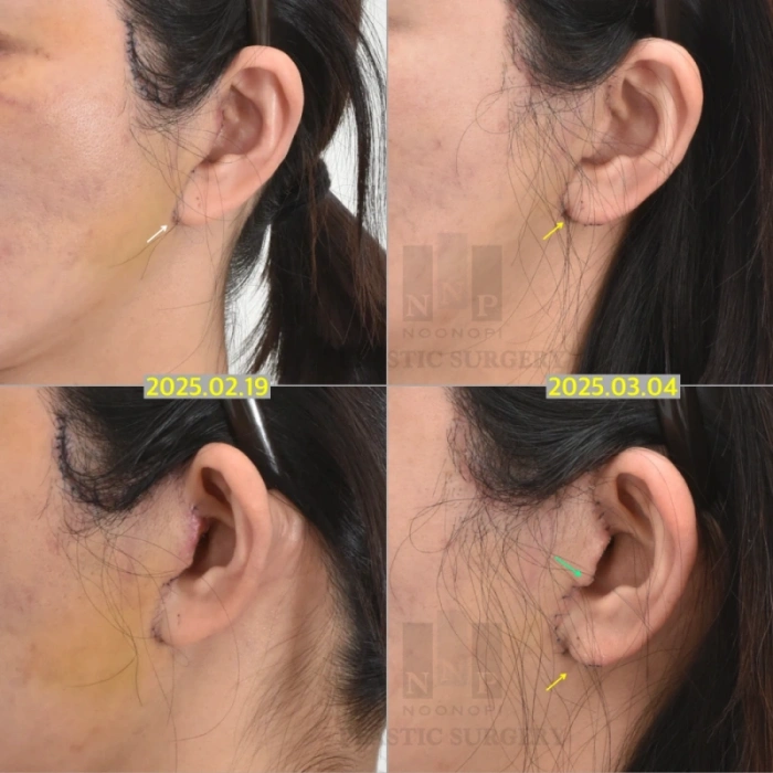 إعادة عملية شد الوجه: لمنع تشوه الصوان وشحمة الأذن الملتصقة