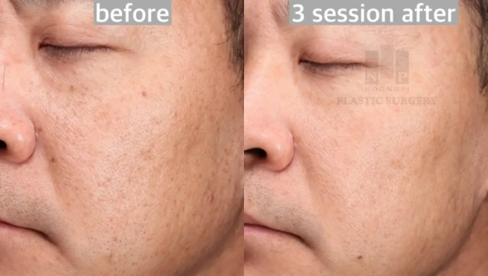 深肤色BBL HERO治疗效果