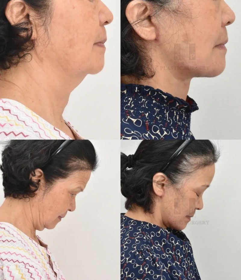 شد الوجه والرقبة: بعد شهرين من العملية