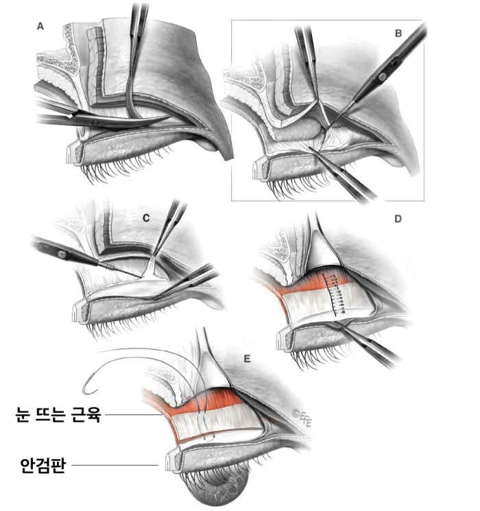 جراحة تدلي الجفن في كوريا