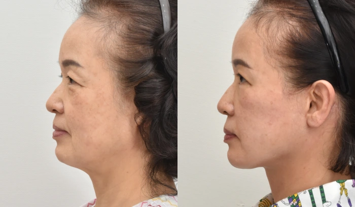 7 أشهر بعد عملية شد الوجه في عيادة نونوبي للطب التجميلي في كوريا