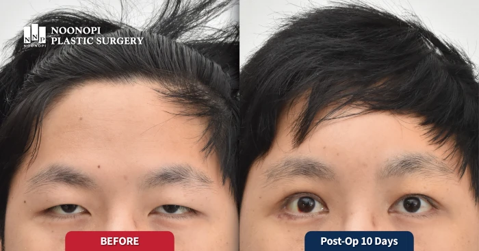 Young patient with heavy lids and early forehead wrinkle symptoms